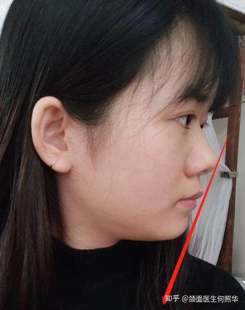想问一下,我这种侧脸怎么改善?