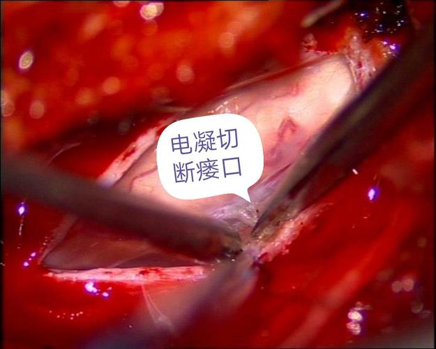 一例罕见的脊髓硬脊膜动静脉瘘