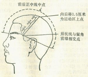 头针疗法亦称头皮针