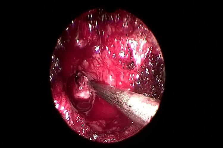 内窥镜辅助下腰椎髓核摘除术 纤维环缝合术