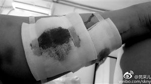 "芫采儿"被流浪狗咬到的小腿6月12日,本报报道了一条流浪狗咬伤十余