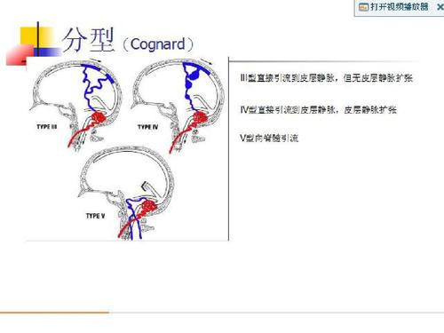 硬脑膜动静脉瘘-张国勇ppt