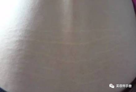 肾虚纹,你有吗?