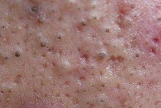 黑头粉刺       黑头是硬化油脂阻塞物,通常出现在颜面的额头,鼻子等