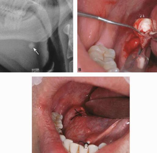 下颌下腺结石的现代治疗方法