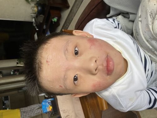 十年湿疹,特应性皮炎.