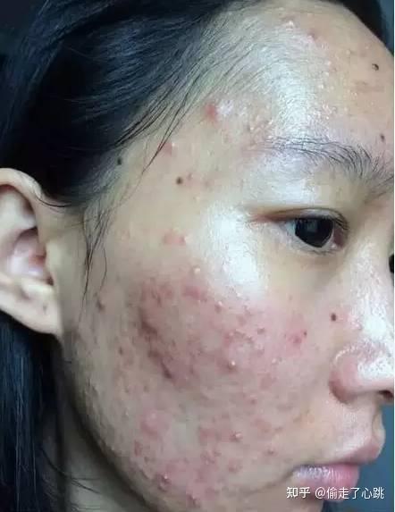 女生找对象会很在意脸上有痘痘还有痘坑痘印的男生吗