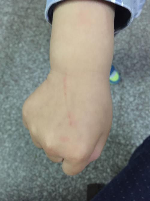 看看这伤口,也不知道是狗狗抓伤还是自己刮伤的,大家鉴定一下