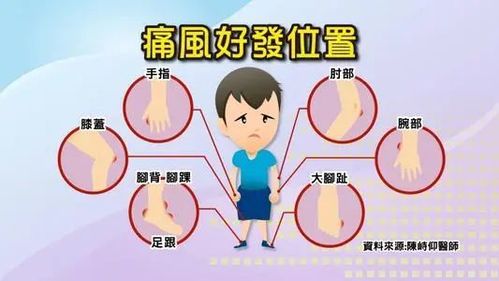 夏日炎炎不可不知关于痛风的事