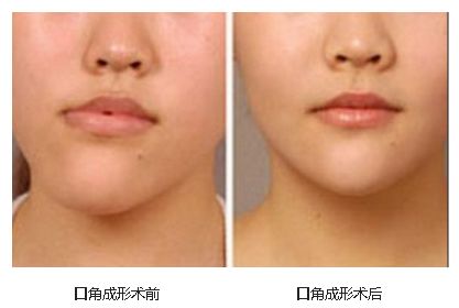 口角歪斜怎么矫正