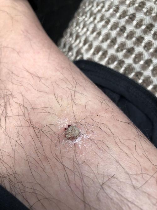 怎么办啊?痒痒 之前每次扣掉就越来越大 现在不抠了 就稳定了