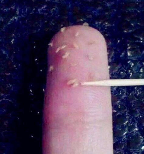 皮肤不好的人,脸上螨虫能达300万只,螨脸4个典型迹象你有吗?