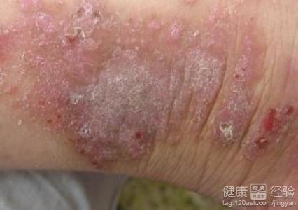 湿疹与神经性皮炎的区别