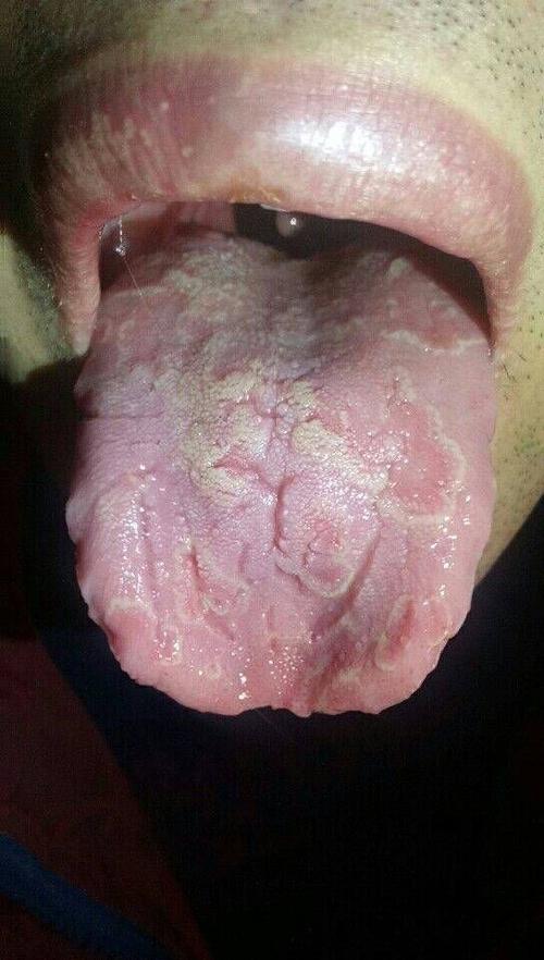 正常人的舌背上有一层薄白而润的苔状物,叫舌苔.