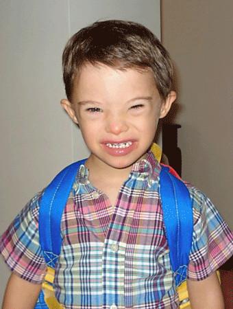 外国唐宝宝照片集唐氏综合症