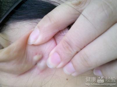 皮脂腺囊肿千万不要手术