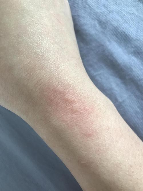 求助,大家看下这个情况是不是猫藓传给人了呀.