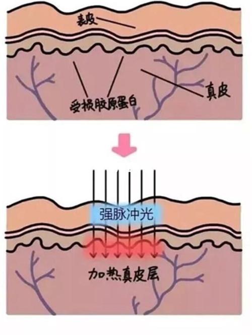 图解光子嫩肤原理94_光子嫩肤_护肤_毛孔粗大_收缩毛孔_改善肤质_我