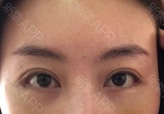 外眼角有一点点疤痕和小肉坨  所以我贴上了