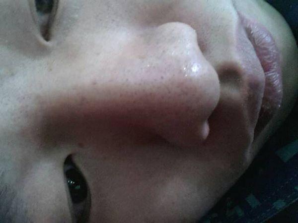 鼻子上的白头粉刺怎么医治