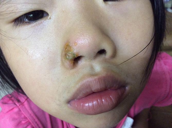 前天早上才发现的,只在鼻子那里,腐烂面积逐渐扩大