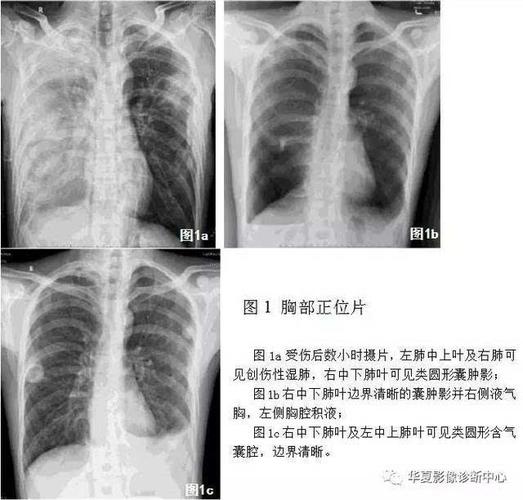 肺气肿,肺大泡,肺气囊有什么不一样?