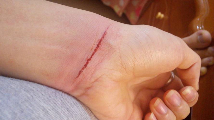 割手腕会死人吗