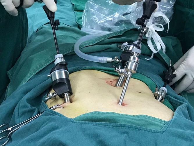 腹腔镜下胃穿孔修补术