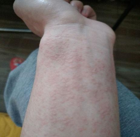 为什么会有紫外线过敏,紫外线过敏如何治疗?