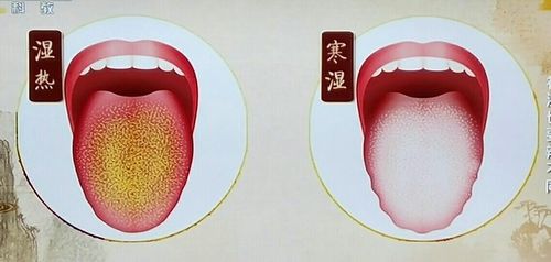 寒湿齿痕明显,舌质偏淡,舌苔白腻.