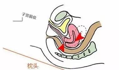 姿势助孕育02借助枕头更易受孕