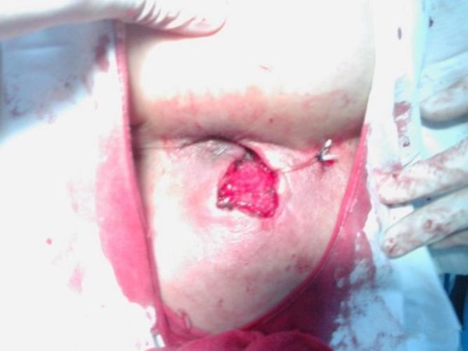 女性肛瘘早期症状的图片