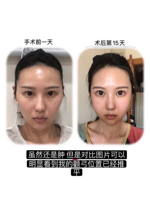 哈喽 今天是我颧骨磨骨颧弓内推术后第15天,整理了一下从手术到现在