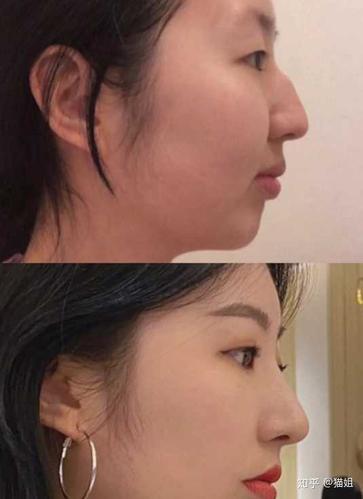 侧脸不好看怎么办?是哪里不协调或者是哪里有缺陷?