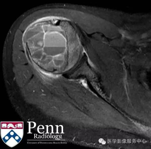 动脉瘤样骨囊肿(abc)