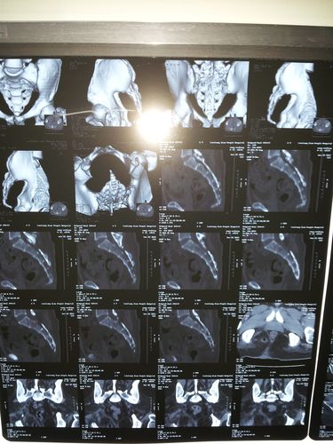 69 骨科与显微外科专业讨论版 69 【原创病例】 因"反复骶尾部