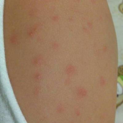 宝宝身上起小红点图片_婴儿各种疹子对应图片