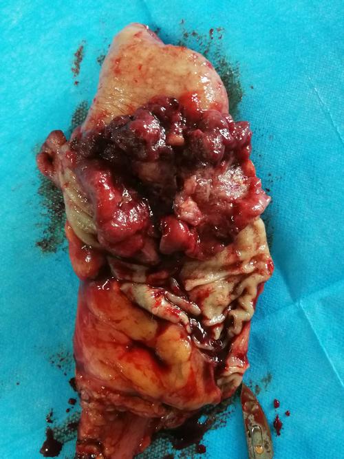 2020收官之作——右半结肠癌根治术