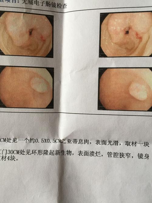 我爸爸查出结肠距肛门30cm处见环形隆起新生物,表面溃烂,管腔狭窄,镜