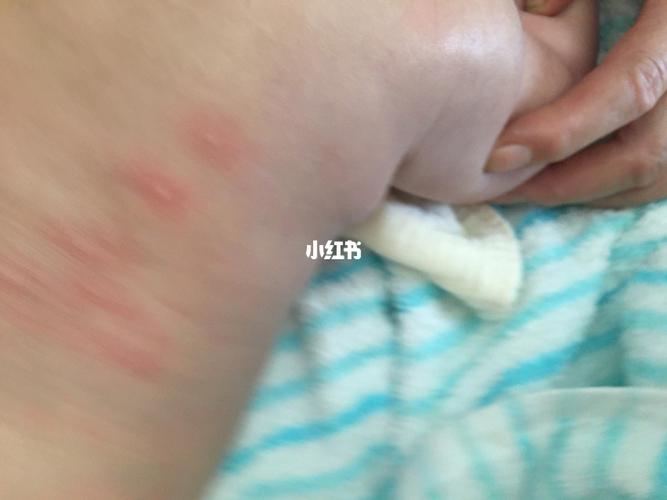 宝宝这是过敏了?还是被虫虫咬了?_过敏_螨虫_白头_母婴_育儿经验