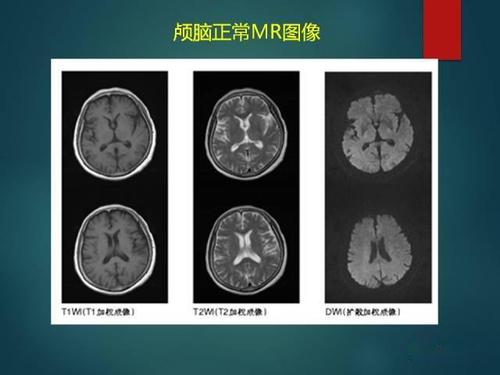 脑白质疏松( la ) : 小动脉病变导致的白质纤维脱髓鞘;t2-f