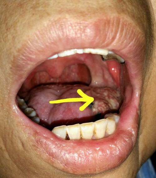 左侧下颌牙龈癌,肿瘤呈"菜花状".如箭头所示.