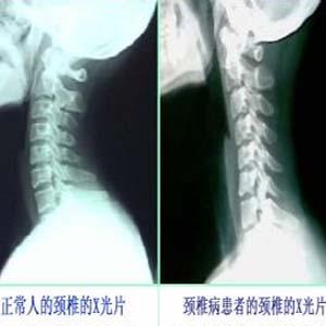 颈椎病x光片