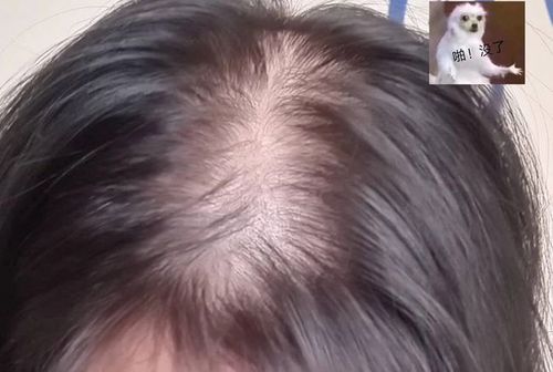 产后脱发严重到只能"剪短发",不会掉光吧?如何有效缓解脱发?