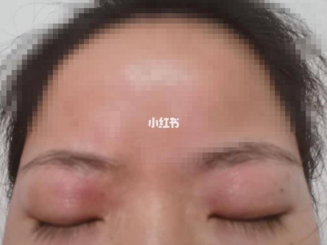 脂溢性皮炎(眼皮红肿消退)_皮炎_夏天去哪玩_汤丽柏琦