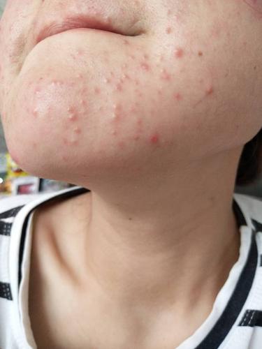 是毛囊炎还是湿疹?,求帮忙看看