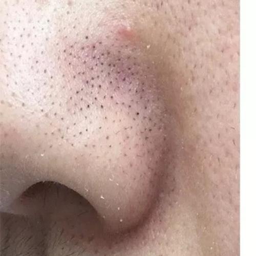 个休止期毳毛残留在毛囊内,残留的毳毛数量可达5-60根,既有黑色角质栓