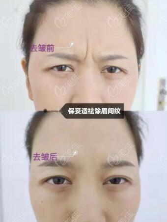 眉间纹重,到石家庄天宏整形做注射除皱效果怎么样?