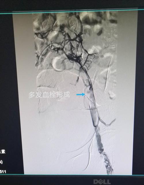左髂静脉压迫综合征合并下肢深静脉血栓介入治疗