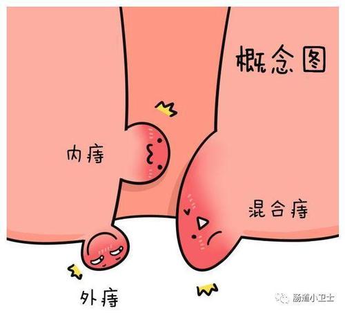 少量出血伴肛门潮湿,瘙痒,轻微疼痛